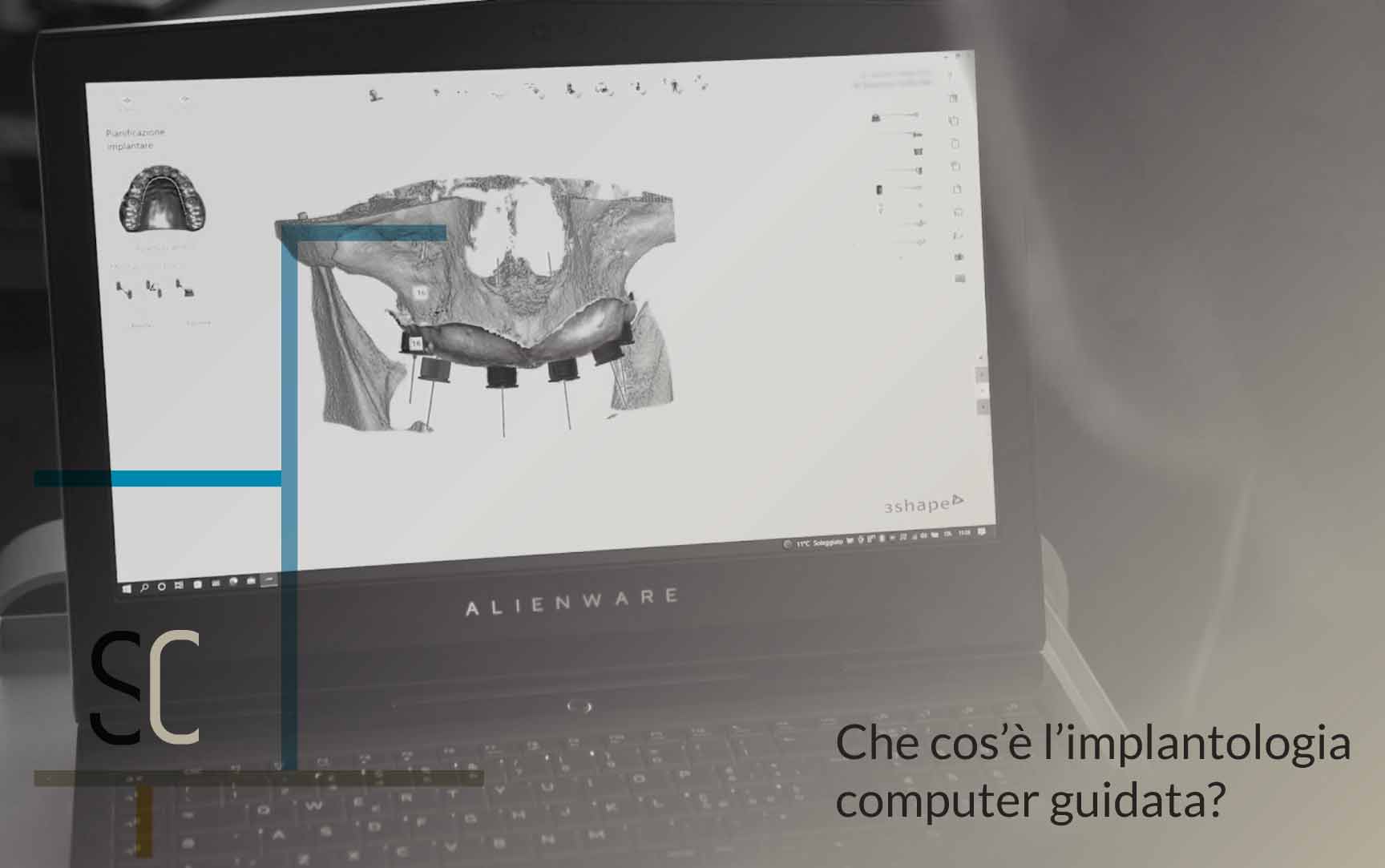 Che cos l implantologia computer guidata